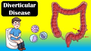 Diverticular Disease And Diverticulitis  Causes Signs amp Symptoms Diagnosis Treatment [upl. by Almeria]