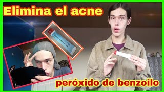 Como usar el Peróxido de Benzoilo para Quitar el Acne [upl. by Grannia777]