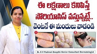 సోరియాసిస్ లక్షణాలు ఇవే  Psoriasis Skin Disease in Telugu  Psoriasis Symptoms  HRC Hospital [upl. by Bush]