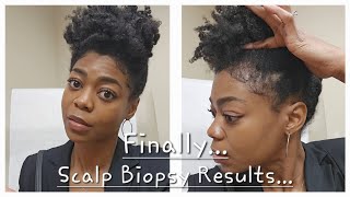 Scalp Biopsy Results Treatment Options amp Venting  4C Natural Hair  Hair Loss [upl. by Issim602]