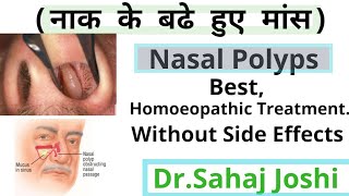 Homoeopathic Medicine For Nasal Polypsनाक के बढे हुए मांस [upl. by Ladnyk]