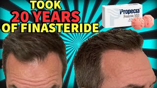 HE TOOK FINASTERIDE FOR 20 YEARS AND THIS IS WHAT HAPPENED [upl. by Imef951]