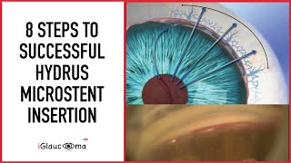 8 Steps to Successful Hydrus Microstent Insertion  Latest 2020 Glaucoma MIGS Surgical Techniques [upl. by Aisena972]