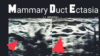 Mammary Duct Ectasia [upl. by Lebbie273]