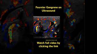 Fournier gangrene radiology radiologyresident medicine ultrasound dermatology [upl. by Stoecker860]