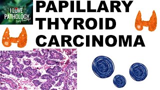 PAPILLARY THYROID CARCINOMA  Gross and Microscopic features [upl. by Renault363]