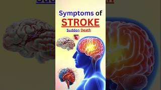 STROKE SYMPTOMS You Wont Believe Are Real [upl. by Urian]