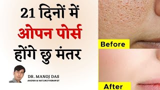 21 दिनों में खत्म Clogged Pores Blackheads Bumps Whiteheads and Large Pores I DR MANOJ DAS [upl. by Nolte914]