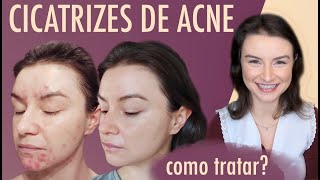 Como eu tratei as minhas cicatrizes de acne  Opinião de Esteticista cicatrizesdeacne [upl. by Naji886]