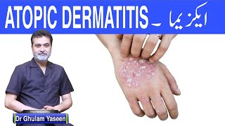 ECZEMA CAUSES SYMPTOMS TREATMENT ایکزیما علامات وجوھات علاج [upl. by Khalid229]