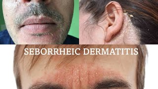 Seborrheic dermatitis  treatment health [upl. by Octavla]