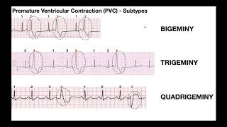 EKG Patterns  Premature Atrial amp Ventricular Contractions PACs amp PVCs [upl. by Orabel]