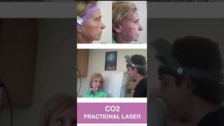 CO2 Fractional Laser Resurfacing [upl. by Leith]