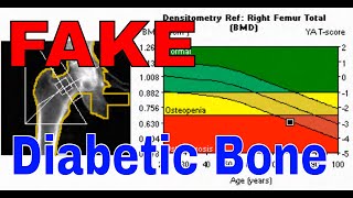 Discovering The Shocking Paradox Of Diabetic Bone Marrow [upl. by Pazice32]