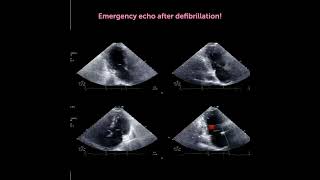 Ultrasound Detective Which coronary artery is occluded echoquiz 123sonography [upl. by Jehanna]