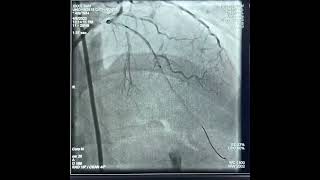 Superdominant RCA 100 stenosis LAD CTO PCI [upl. by Koal964]