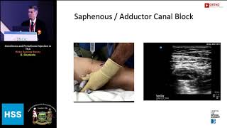 Anesthesia and Periarticular Injection in TKA Motor Sparing Blocks  Dr E Goytizolo [upl. by Eedia]