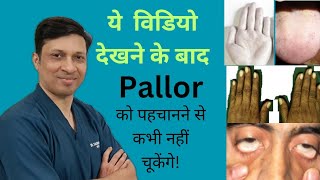 Pallor ExaminationPallor meaningPallor grading in hindi [upl. by Talbot]