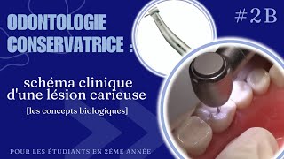 odontologie conservatrice  schéma clinique dune lésion carieuse part2 [upl. by Buskirk431]