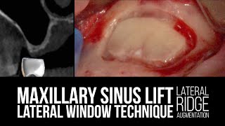 Maxillary Sinus Lift with Lateral Window Technique with Lateral Ridge Augmentation [upl. by Mackoff]