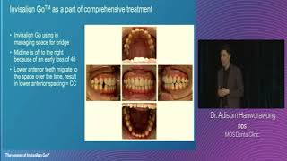 How do Invisalign solve the dental and the esthetic problems [upl. by Tiertza]