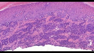 Small cell melanoma Phillip McKee Antonina Kalmykova CSD Health Care [upl. by Ogu]