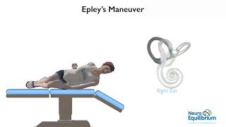 Epley Maneuver A Step by Step Guide to Treat BPPV Vertigo [upl. by Liw]