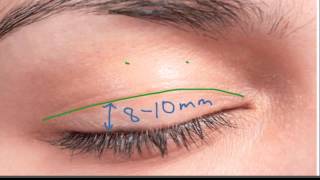 Marking the Upper Eyelid Incision [upl. by Gnous]