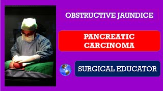 PANCREATIC CANCER How To DIAGNOSE amp TREAT Obstructive Jaundice [upl. by Asina]