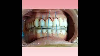 Gingivectomy after 10 days [upl. by Kendall]