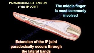 Lumbrical Plus Finger  Everything You Need To Know  Dr Nabil Ebraheim [upl. by Isej]