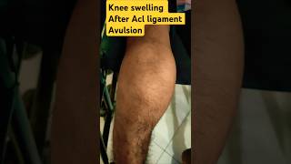 Knee Swelling after Acl ligament avulsion knee Effusionknee injuryACL completepartial tear [upl. by Soilisav]