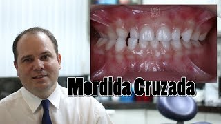 Mordida Cruzada aos 5 anos  comentando [upl. by Eniamirt]