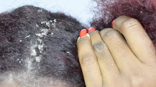 ITCHY DRY SCALP  SCRATCHING DANDRUFF [upl. by Yllime]