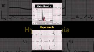 Hypothermia ECG J point elevation [upl. by Shriver700]