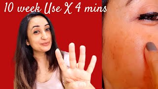 Be Minimalist Tranexamic AcidSerum 10 WEEK Live Result Mini Product Review 4Min Review [upl. by Norha897]