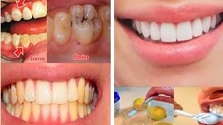 Eso Que Ves Eran Mis Dientes Con Caries Y Amarillos Pero Con Esta Receta Los Puse Mejor [upl. by Ppik]