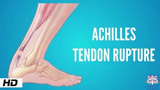 Achilles tendon rupture Causes Signs and Symptoms Diagnosis and Treatment [upl. by Biggs609]