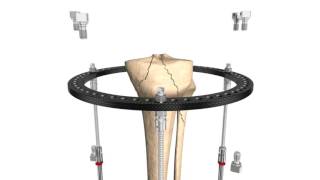 Stryker Trauma amp Extremities  Hoffmann LRF Circular External Fixation [upl. by Adigirb]