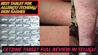 BEST TABLET FOR ALLERGY AND SKIN RASHES AND ITCHINGCETZINE TABLET USES DOSE FULL REVIEW IN TELUGU [upl. by Modestia]