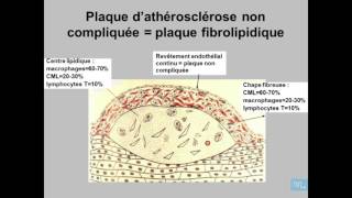 Athérosclérose Anatomie Pathologique Partie 2 [upl. by Dov]