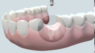 Cómo se coloca un implante dental [upl. by Ehtiaf482]