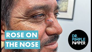 Dr Pimple Popper Opens A Rose on the Nose [upl. by Myles382]