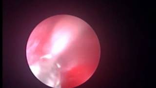 Azayem Technique  Endoscopic management of complete ureteral avulsion from UVJ [upl. by Atnom754]