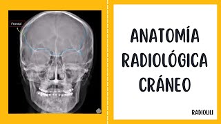 Anatomía Radiológica  Radiología Convencional Cráneo  Proyecciones de Cadwel Lateral y Waters [upl. by Aerdnaed]