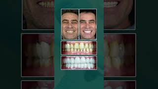 Zirconium Crown Transformation A Smile Built to Last 15 Years [upl. by Annait910]