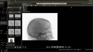 Case 1 AVM Corpus Callosum 11082024 [upl. by Hpeseoj]