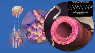 Pathology of Pulmonary Hypertension and Right Heart Failure [upl. by Siana]