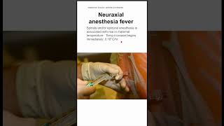 Neuraxial anesthesia fever [upl. by Eenel760]