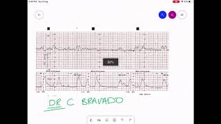 CARDIOTOCOGRAPHY  CTG INTERPRETATION [upl. by Desiree]